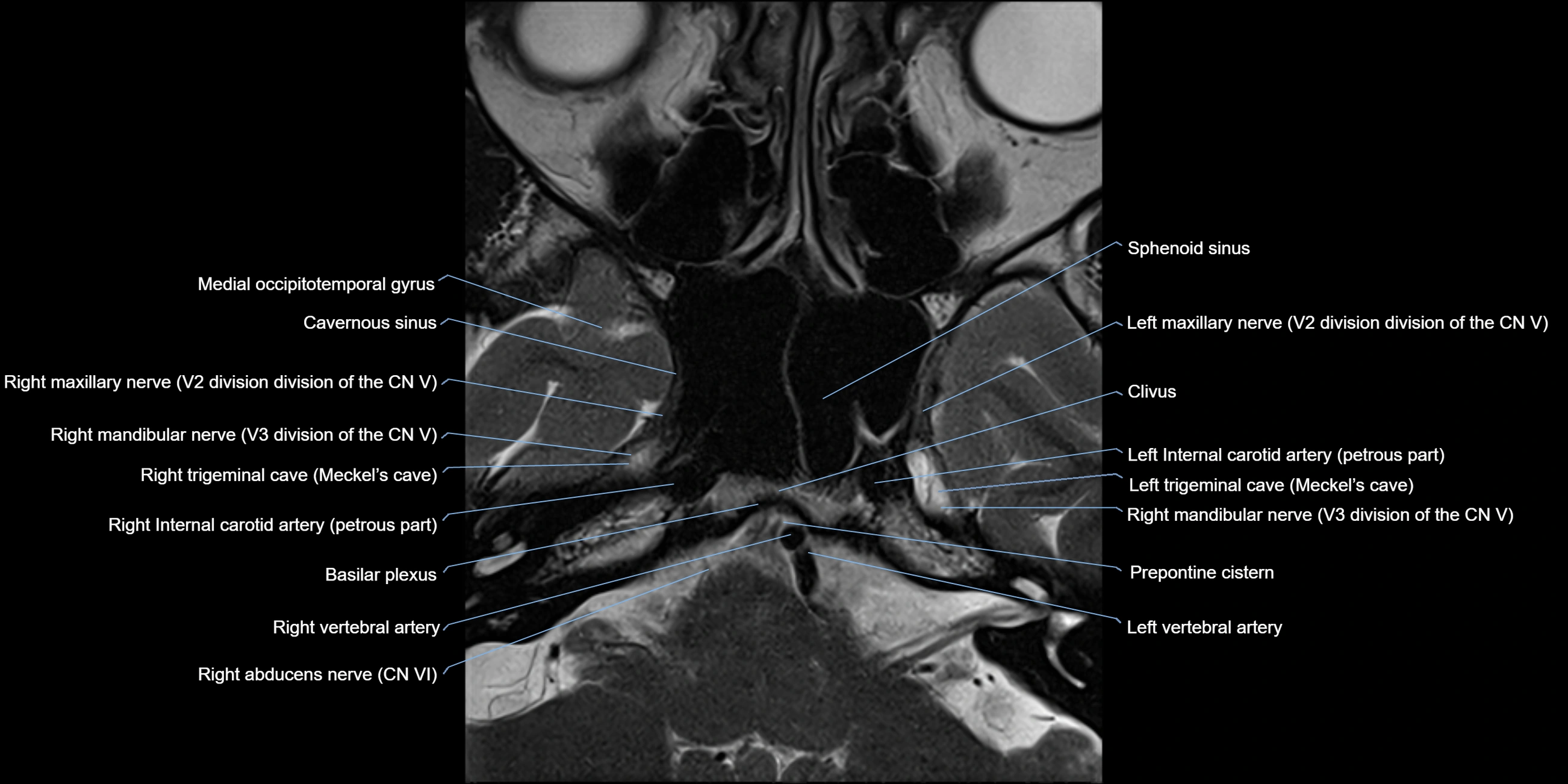 MRI cavernous sinus axial cross sectional 3T anatomy image-img-11001-00004.webp